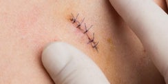 Unlocking the Specialty of Suture Removal At Home in Dubai: A Comprehensive Guide