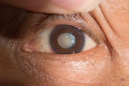 Expert Cataract Surgery in Australia: Restore Your Vision with Vision for Life